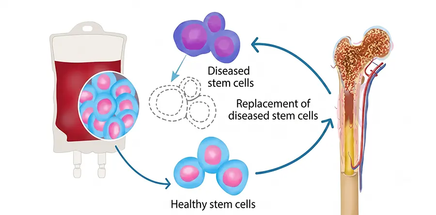Bone marrow hematopoietic stem cell transplantation